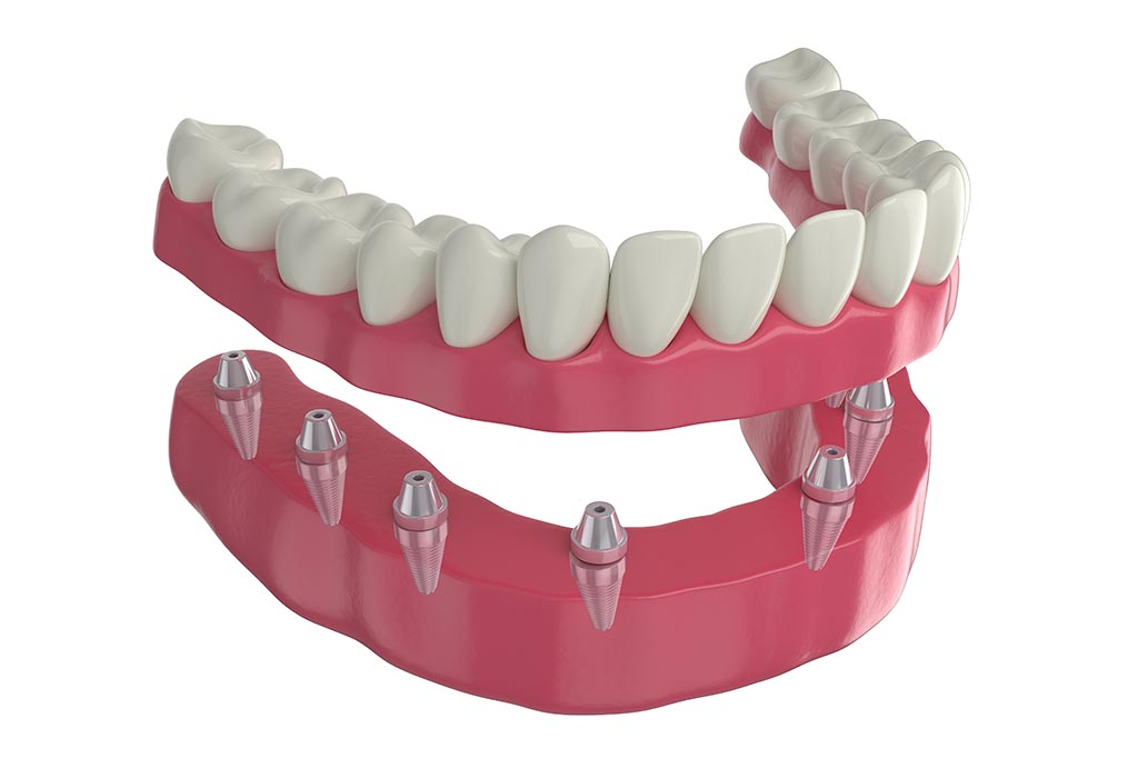 Todo sobre los puentes dentales