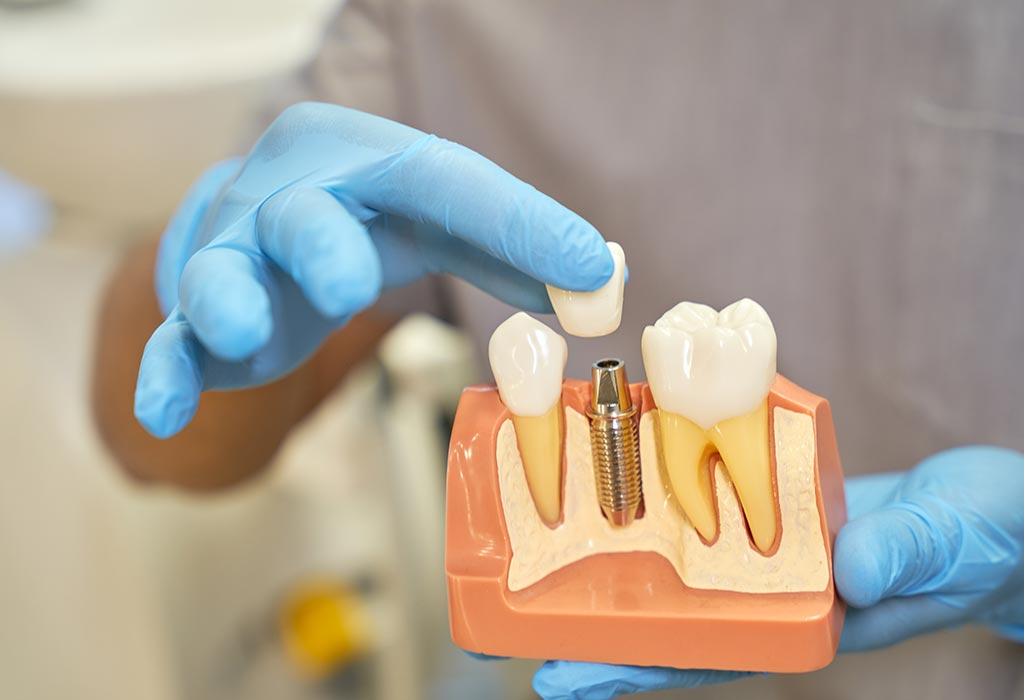 Todo sobre los puentes dentales