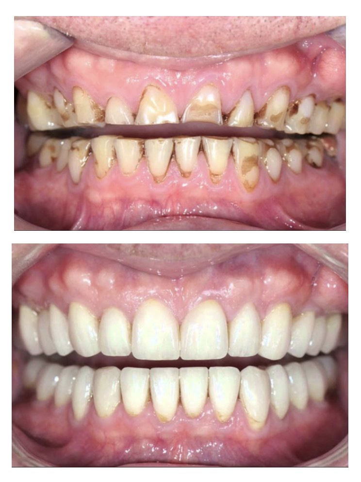 Blanqueamiento dental vs. carillas: ¿Cuál es la mejor opción estética en Terrassa? 3 https://ikonicdental.com/terrassa/blanqueamiento-dental-vs.-carillas:-cual-es-la-mejor-opcion-estetica-en-terrassa