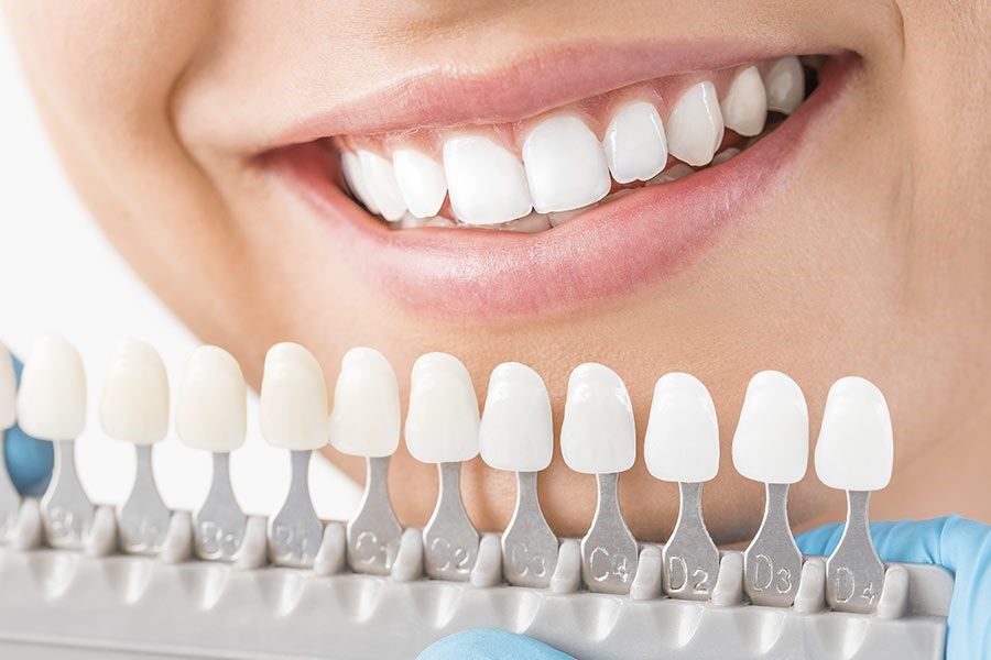 Blanqueamiento dental vs. carillas: ¿Cuál es la mejor opción estética en Terrassa? 4 https://ikonicdental.com/terrassa/blanqueamiento-dental-vs.-carillas:-cual-es-la-mejor-opcion-estetica-en-terrassa