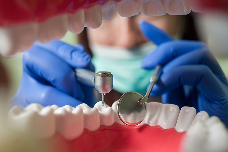 ¿Qué otra opción hay aparte de la endodoncia?