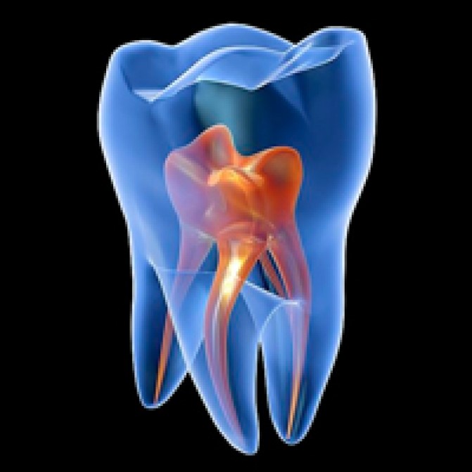 ¿Qué es preferible, sacar la muela o hacer una endodoncia?