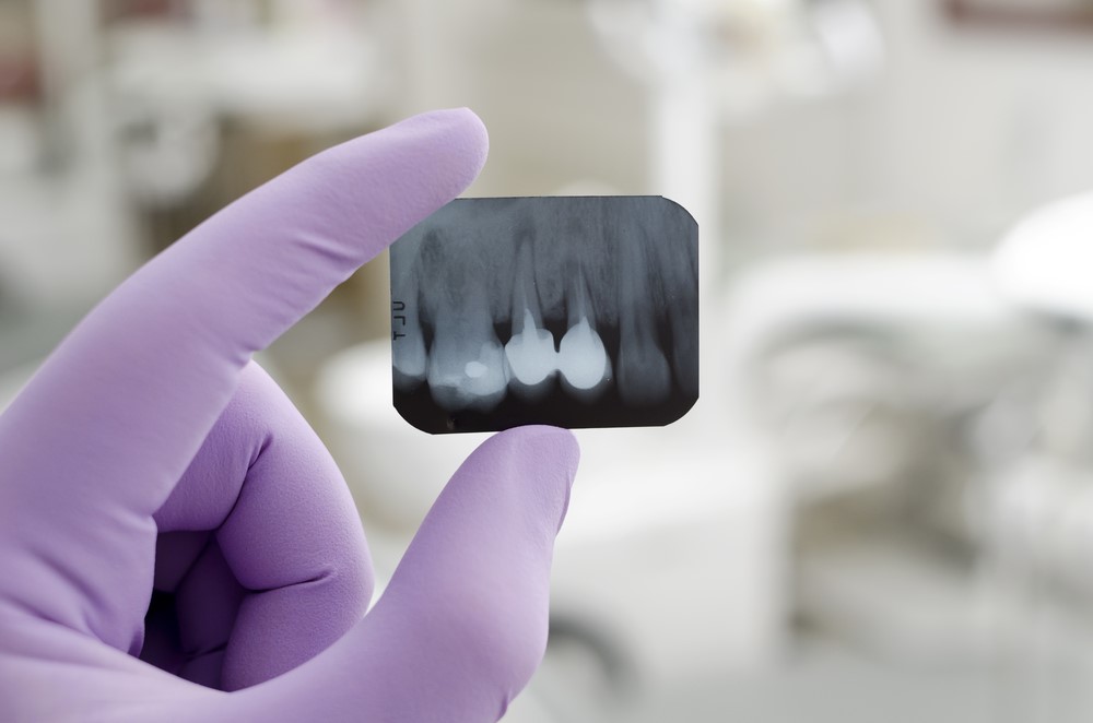 ¿Cuántas sesiones se necesitan para hacer una endodoncia?