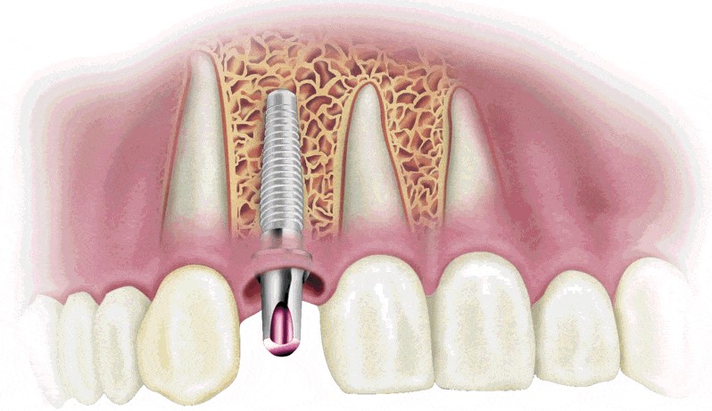 ¿Qué tipo de implantes dentales hay, y cuál es más recomendable?