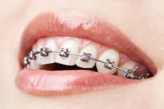 ¿Cuál es la diferencia entre ortodoncia y brackets, y entre brackets e Invisalign?