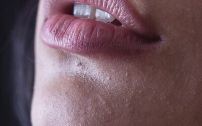 ¿Qué es el síndrome de boca seca?
