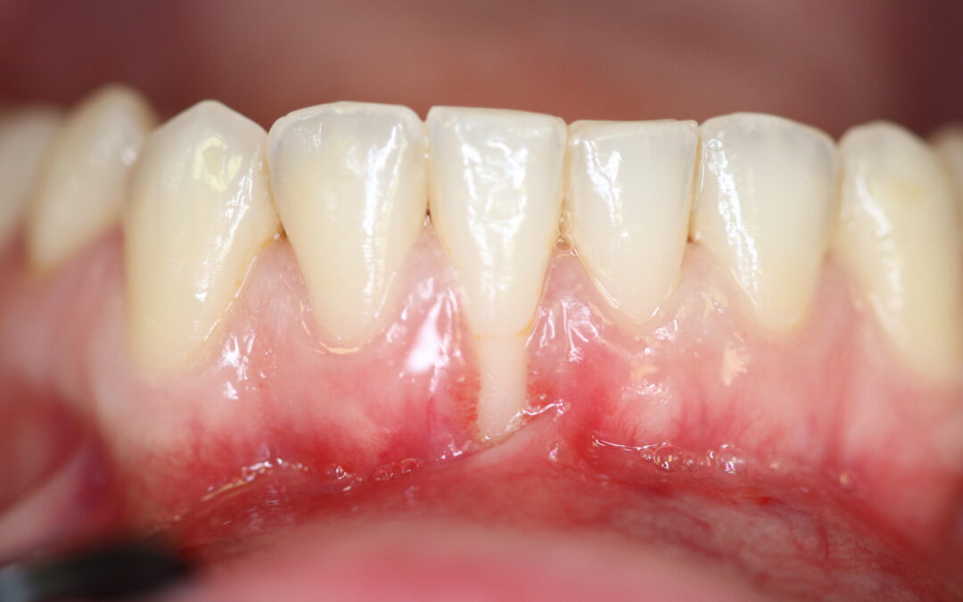 Éxito de Ikonic Dental: El Proceso Detrás de un Injerto Dental en Adolescente 😷