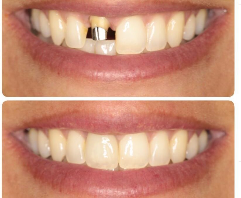 Sonrisa Impactante: Renueva tu Estética Dental con Cambio de Coronas 🦷🤩
