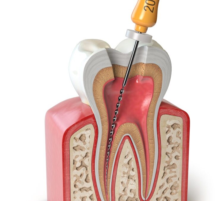 ¿Cuánto tiempo tarda en hacer una endodoncia? (Agrupando preguntas sobre la duración del procedimiento)