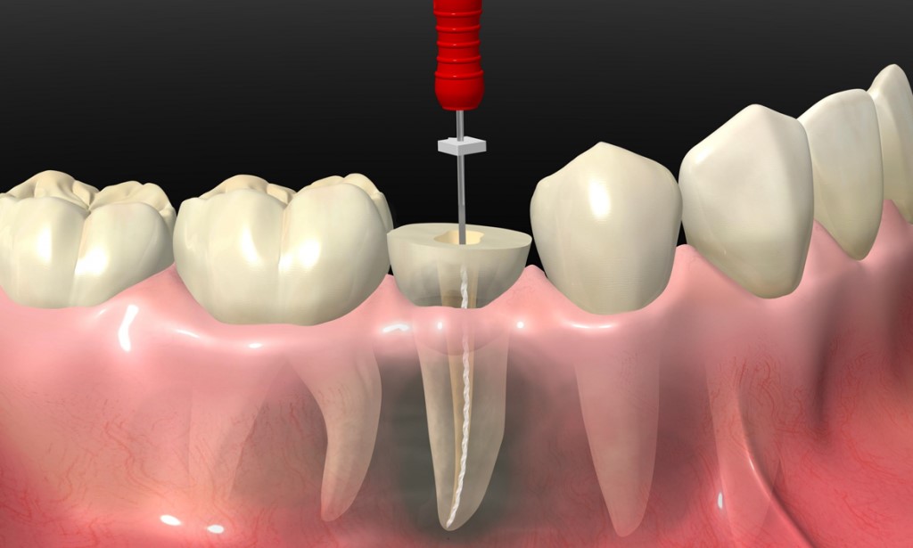 ¿Qué tan dolorosa es la endodoncia?