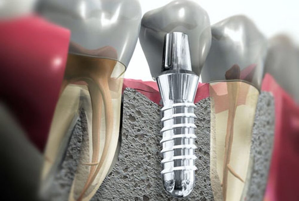 ¿Cuáles son los riesgos de un implante dental y cómo saber si se rechaza un implante?