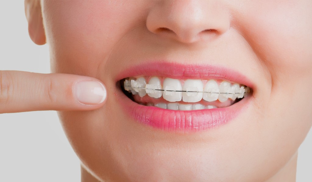 ¿Cuándo es necesaria la ortodoncia, quién necesita una, y qué pasa si no se hace el tratamiento?
