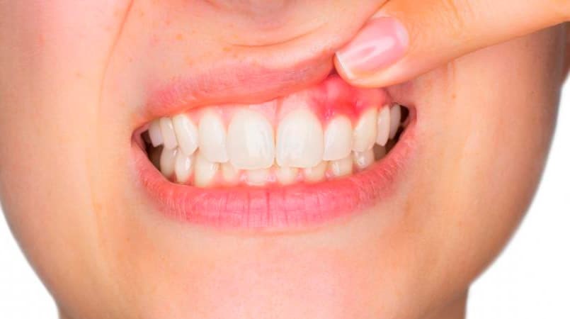 ¿Qué hace la periodoncia, qué se hace en un tratamiento de periodoncia, y qué incluye periodoncia?