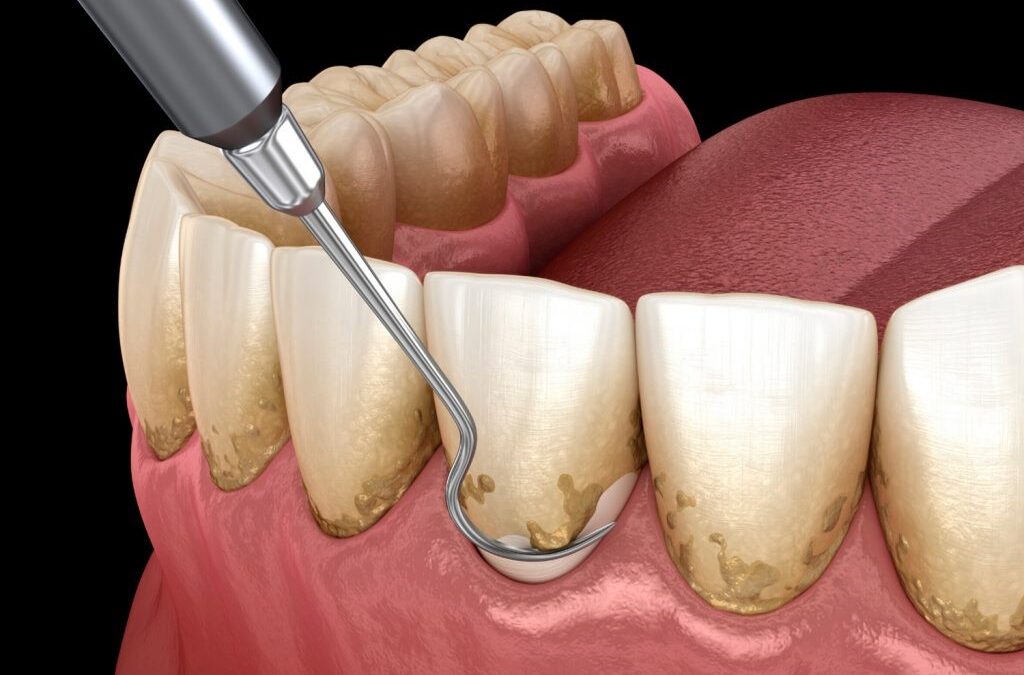 ¿Cómo queda la encía después de una limpieza y cuándo debo visitar a un periodoncista?