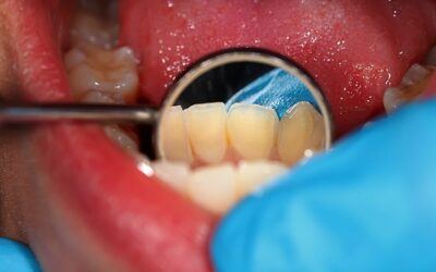 ¿Qué pastillas son buenas para desinflamar las encías y qué enjuague usar para periodontitis?