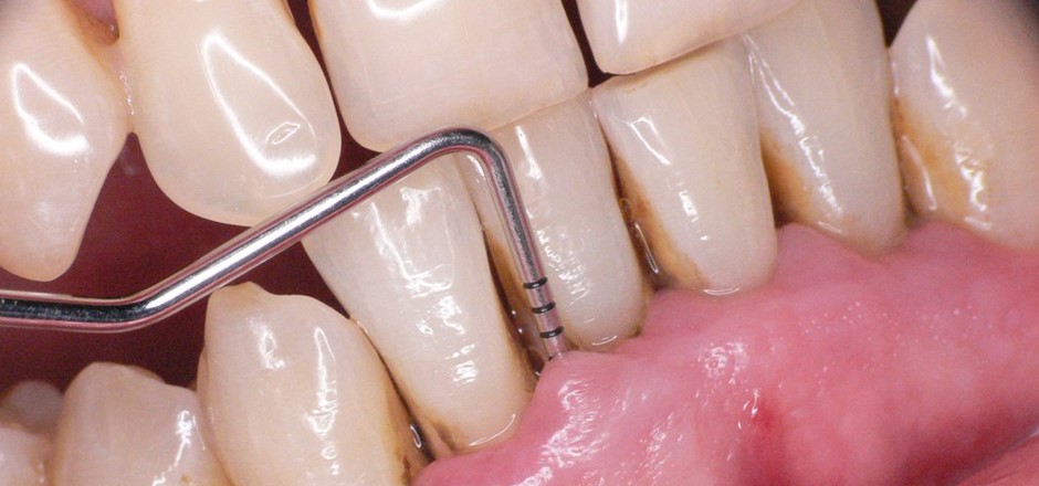¿Cuántos tipos de periodoncia hay, cómo se hace una cirugía periodontal, y cómo es la limpieza de encías?