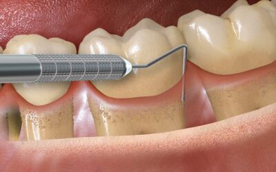 ¿Cómo se ve la periodontitis inicial y cómo saber si la periodontitis está avanzada?