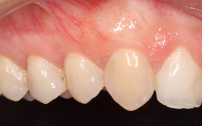 ¿Cuánto tiempo tarda en cicatrizar la encía después de un curetaje y qué sigue después de la periodontitis?