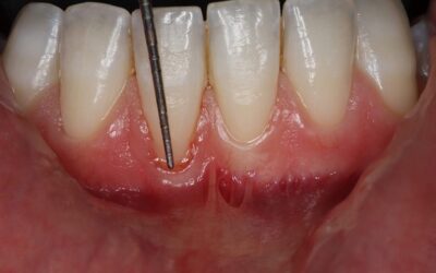 Cómo recuperar encías retraídas con tratamientos periodontales avanzados