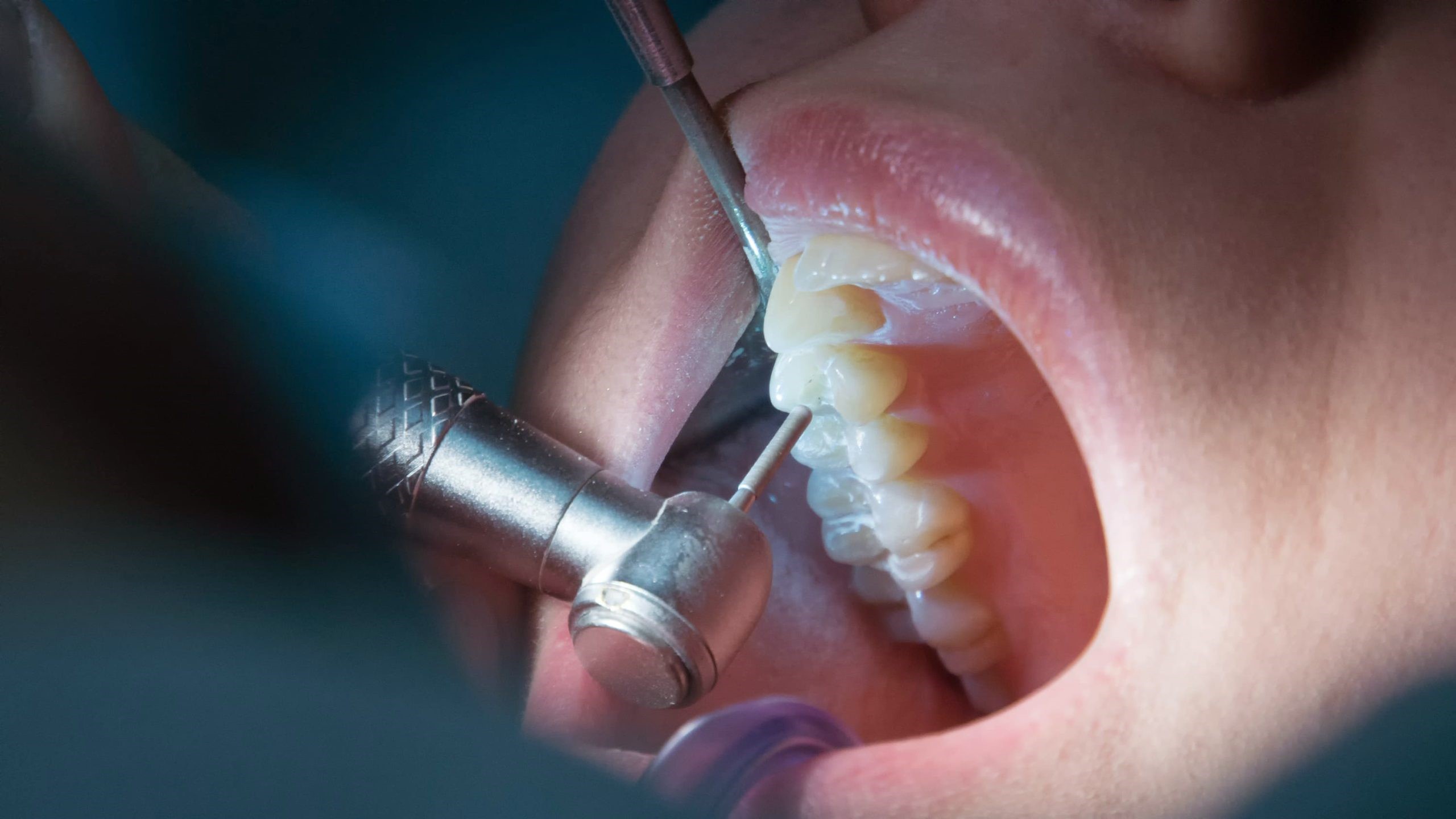 qué-es-la-endodoncia-y-cuánto-cuesta-agrupando-preguntas-sobre-costos-y-especificaciones-de-la-endodoncia-en-españa-2023